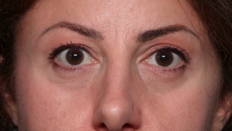 Blepharoplasty and Brow Lift Before & After Patient #34363